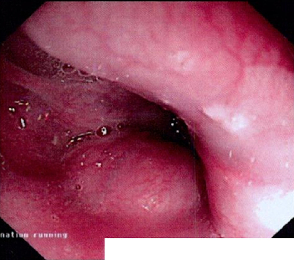 Esophageal endoscopy showing severe esophageal luminal narrowing with intact overlying mucosa.