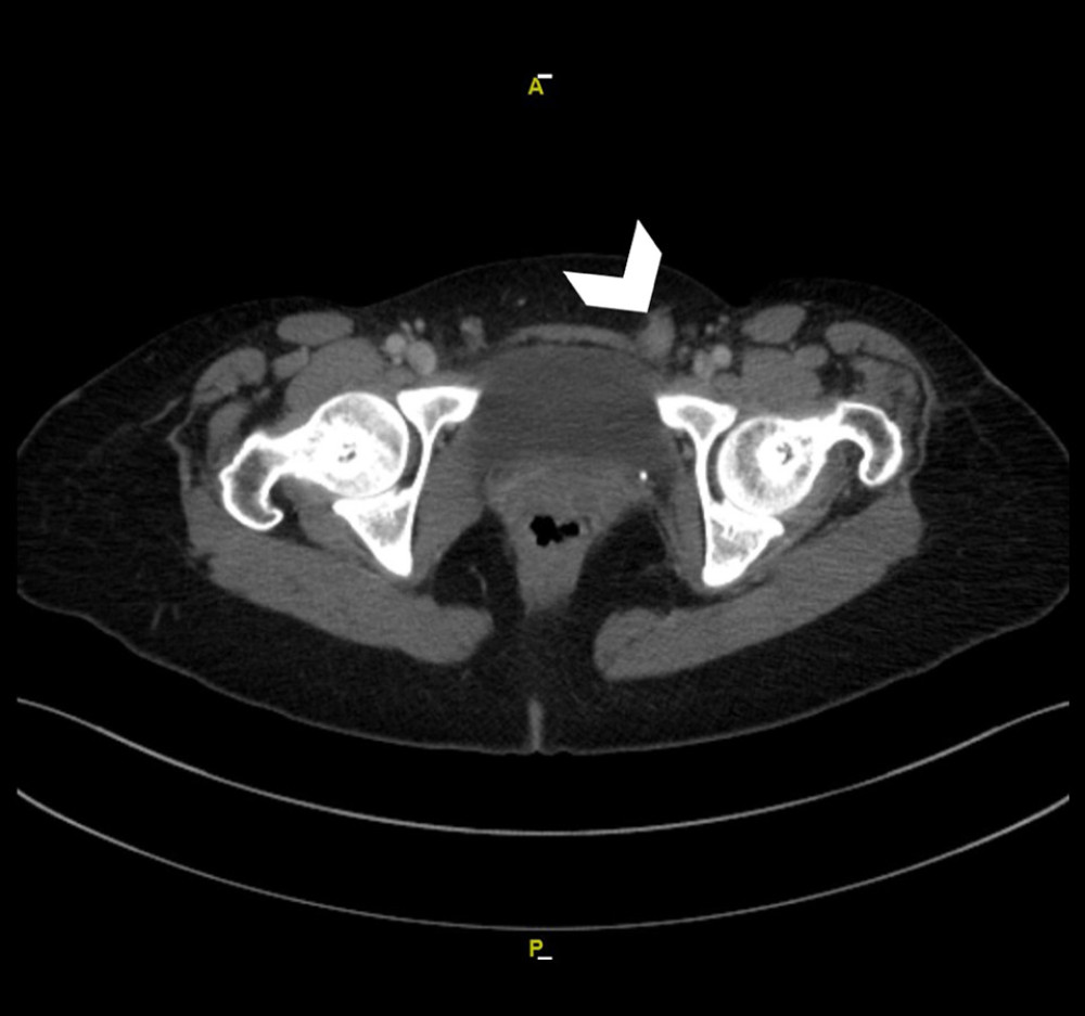 Computed tomography (CT) of the pelvis showing left inguinal lesions measuring 1.7×1.2 cm (arrowhead).