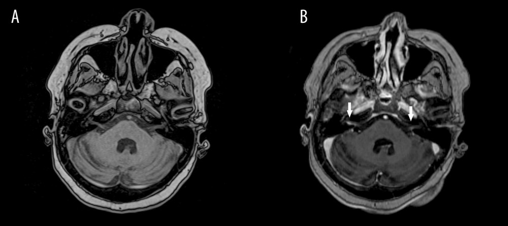 Cerebral MRI on hospital day 12 showing contrast enhancement of the acustico-vestibular bundles. A and B show the same coordinates before and after contrast, respectively. Arrows point to the zones of contrast enhancement.