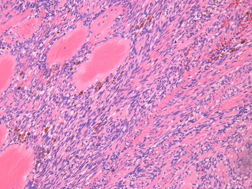 Spindle cell proliferation with typical amianthoid fibers and hemosiderin pigment (Hematoxylin and Eosin staining, 100× magnification).