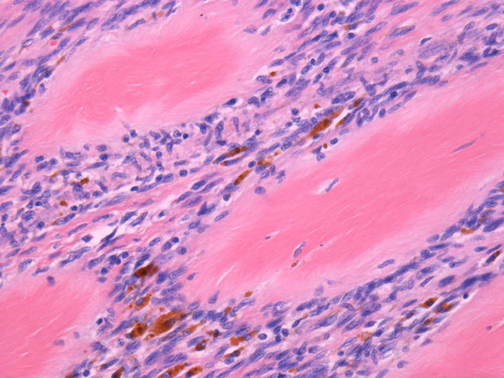 High-power view of amianthoid fibers and pigmented macrophages (hematoxylin and eosin staining, 200× magnification).
