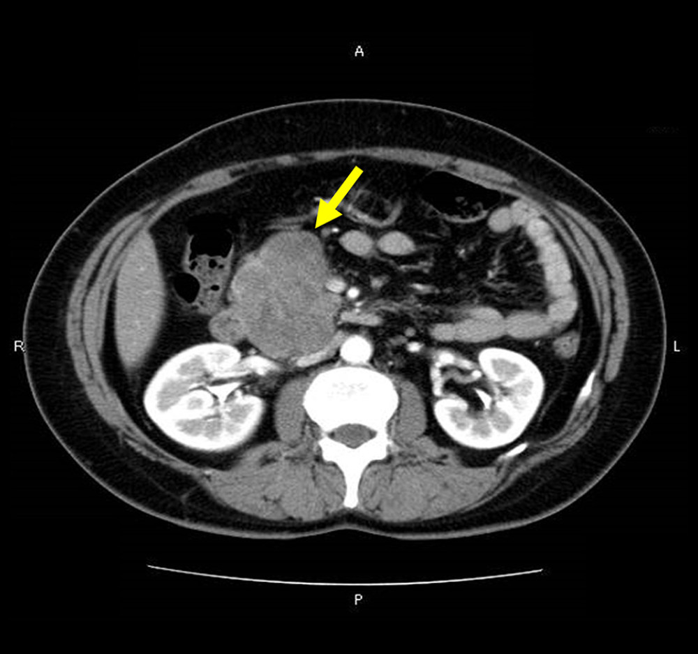 Comuputed tomography showing a 73×43-mm heterogeneous mass (thick arrow) in the pancreatic head.