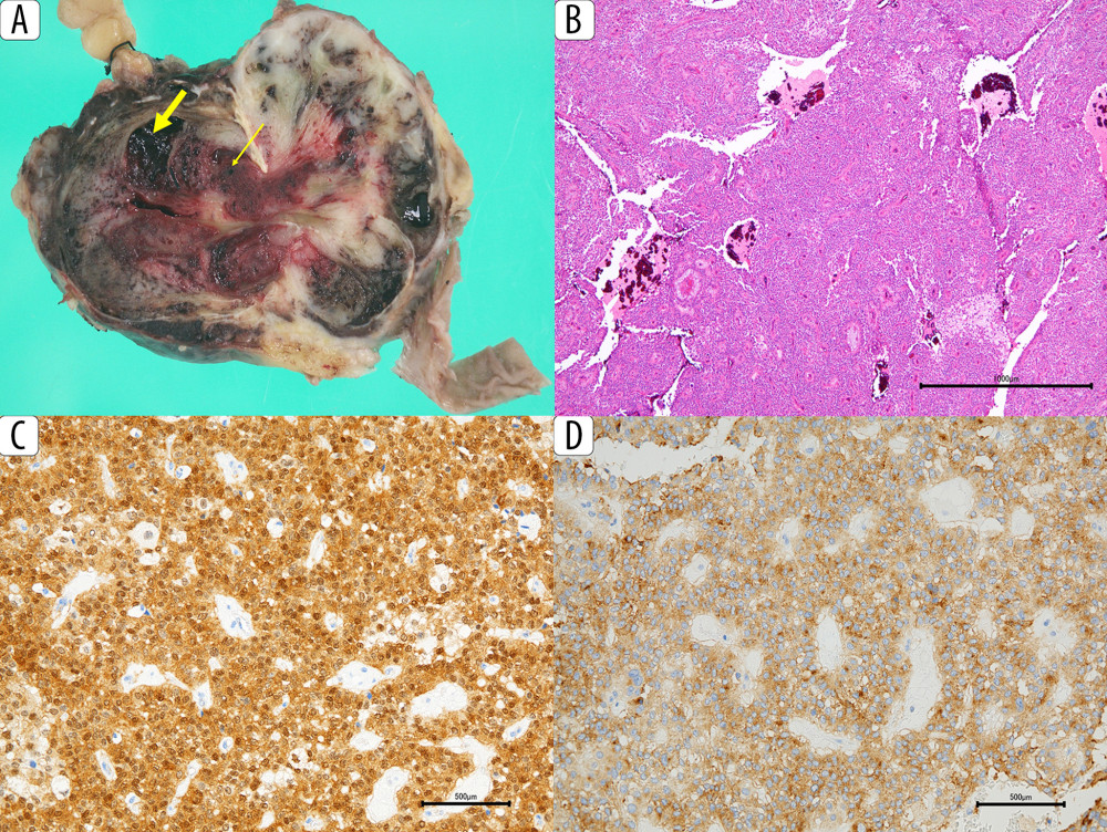 Characteristics of the primary tumor. (A) Macroscopic appearance of solid pseudopapillary tumor of the pancreas, showing mainly hemorrhage (thin arrow) and necrosis (thick arrow). (B) Image demonstrates an atypical pseudopapillary architecture. (C) The tumor shows positive staining for β-catenin. (D) The tumor shows positive staining for CD10.