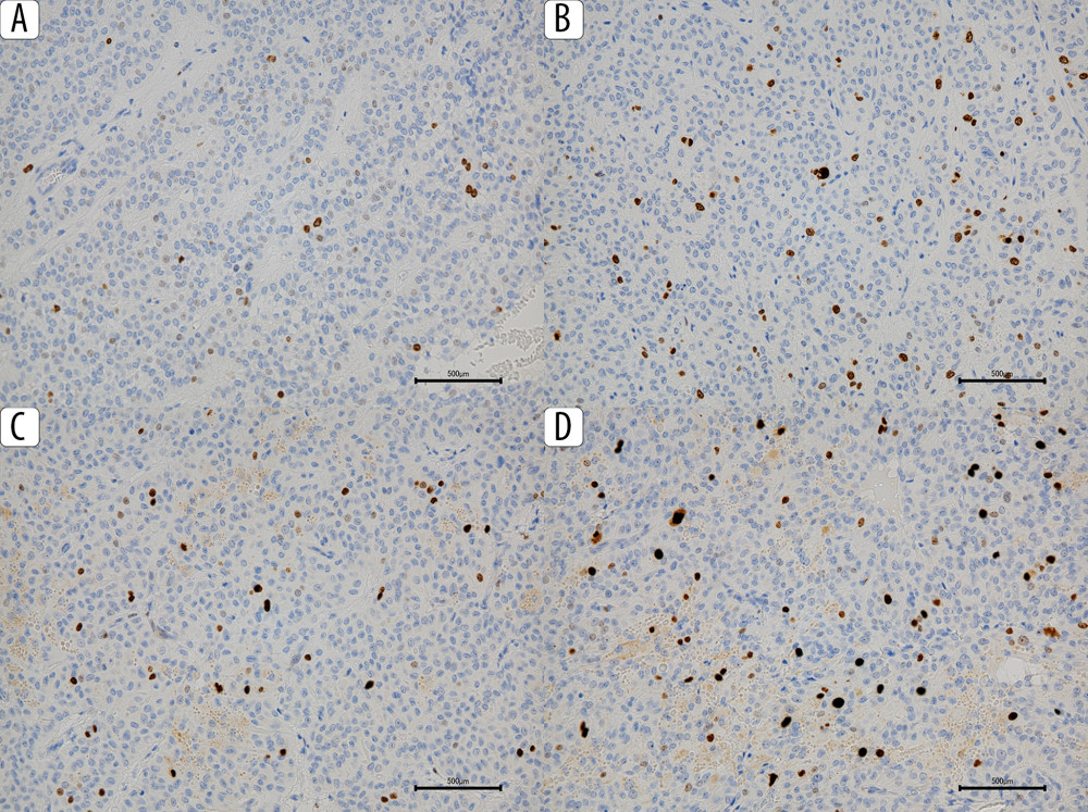 Changes in Ki-67 labeling index, showing an overall increasing trend. (A) Primary tumor. (B) Specimen resected at second surgery. (C) Specimen resected at third surgery. (D) Specimen resected at fourth surgery.