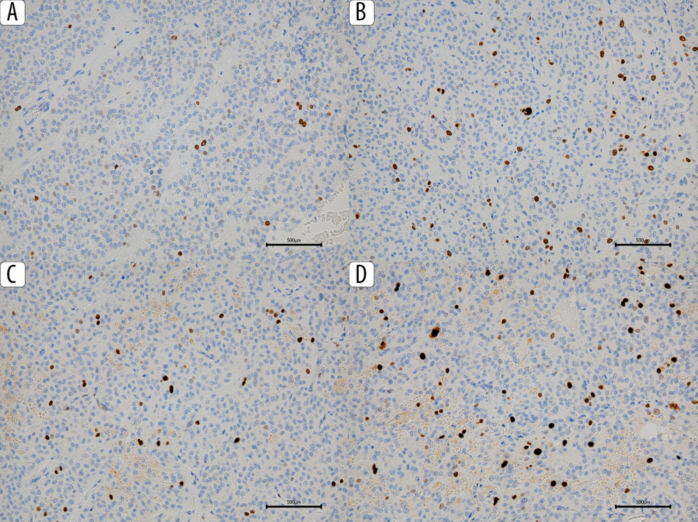 Changes in Ki-67 labeling index, showing an overall increasing trend. (A) Primary tumor. (B) Specimen resected at second surgery. (C) Specimen resected at third surgery. (D) Specimen resected at fourth surgery.