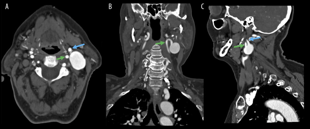 CT Angiogram demonstrating the ICA aneurysm in axial (A), coronal (B), and sagittal (C) planes. The inflow of the aneurysm (green arrow) and outflow (blue arrow) is best appreciated in the sagittal plane.