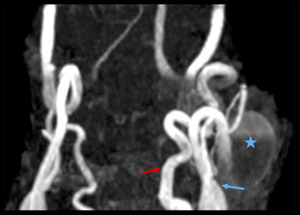 MRI angiogram demonstrating the ICA aneurysm and filling within the aneurysm sac. The internal carotid artery is indicated by the blue arrow, the aneurysm sac by the star, and the external carotid artery by the red arrow.