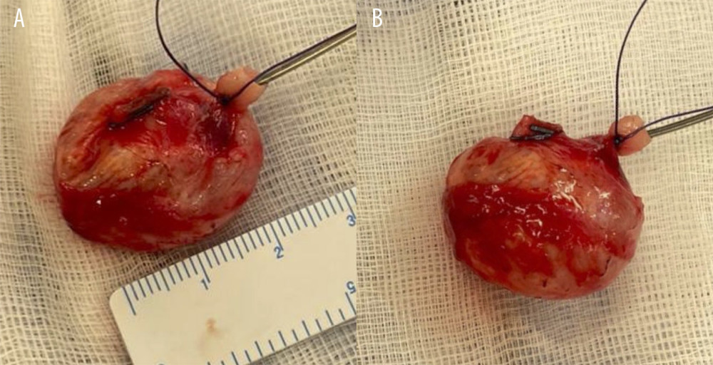 (A, B) Left internal carotid artery aneurysm post excision. LIGACLIPs™ (Ethicon Medical, OH) are seen on the proximal ICA, and a tie on the distal ICA.