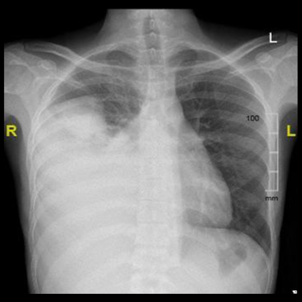 Chest X-ray demonstrating the presence of pleural effusion with homogenous opacity over the right hemithorax preserving the upper lobe.