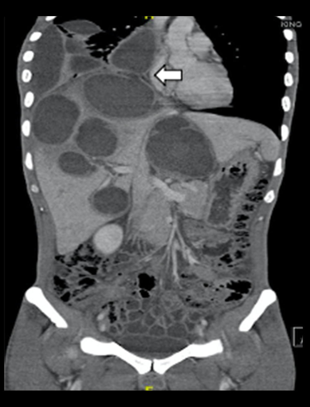 Contrast-enhanced computed tomography scan of the abdomen showing massive hepatomegaly with multiple hypodense lesions communicating with the mediastinum and the pleural cavity (white arrow indicates the point of communication).