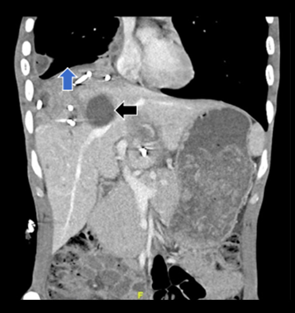 Computed tomography scan of the abdomen after 21 days of treatment illustrating the substantial regression in size of all previously noted collections, including hepatic abscesses (black arrow), pleural empyema (blue arrow), and mediastinal collection.
