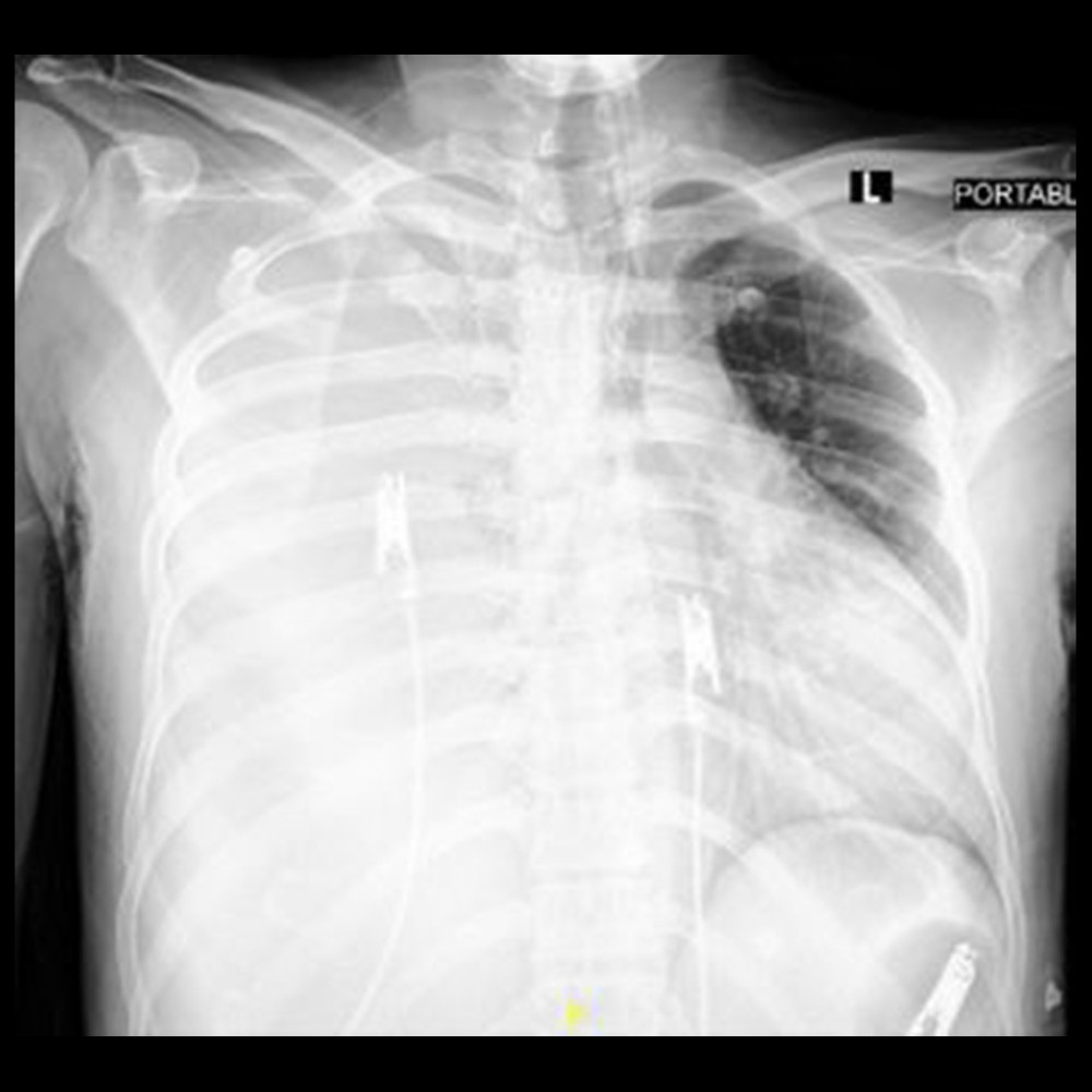 Chest X-ray clearly showing evidence of massive pleural effusion over the right lung with subsequent contralateral shift of the mediastinal structures.