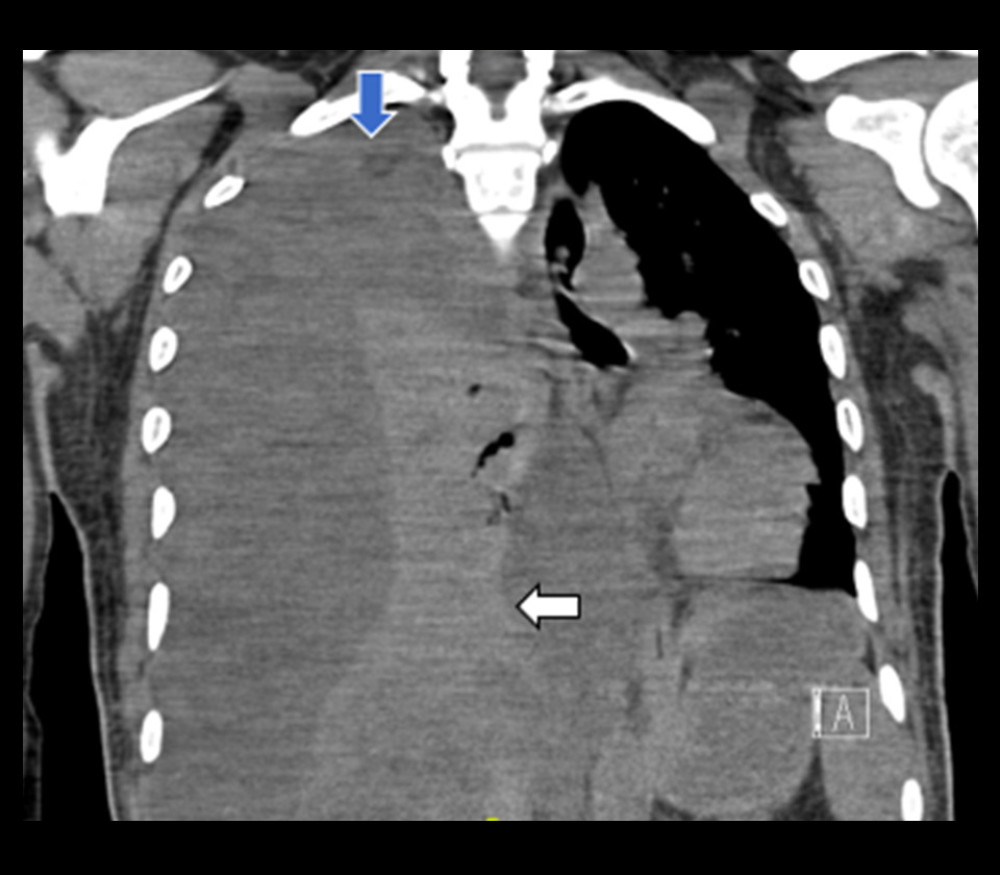 Non-contrast-enhanced computed tomography scan of the chest illustrating massive right-sided pleural effusion (blue arrow) with complete collapse of the right lung and intraabdominal communication (white arrow).