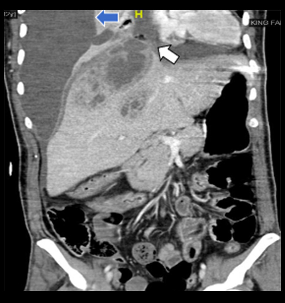 Computed tomography scan of the abdomen showing the multiseptated lesion abutting the right hemi-diaphragm (white arrow) and resulting in transdiaphragmatic extension with empyema thoracis (blue arrow).