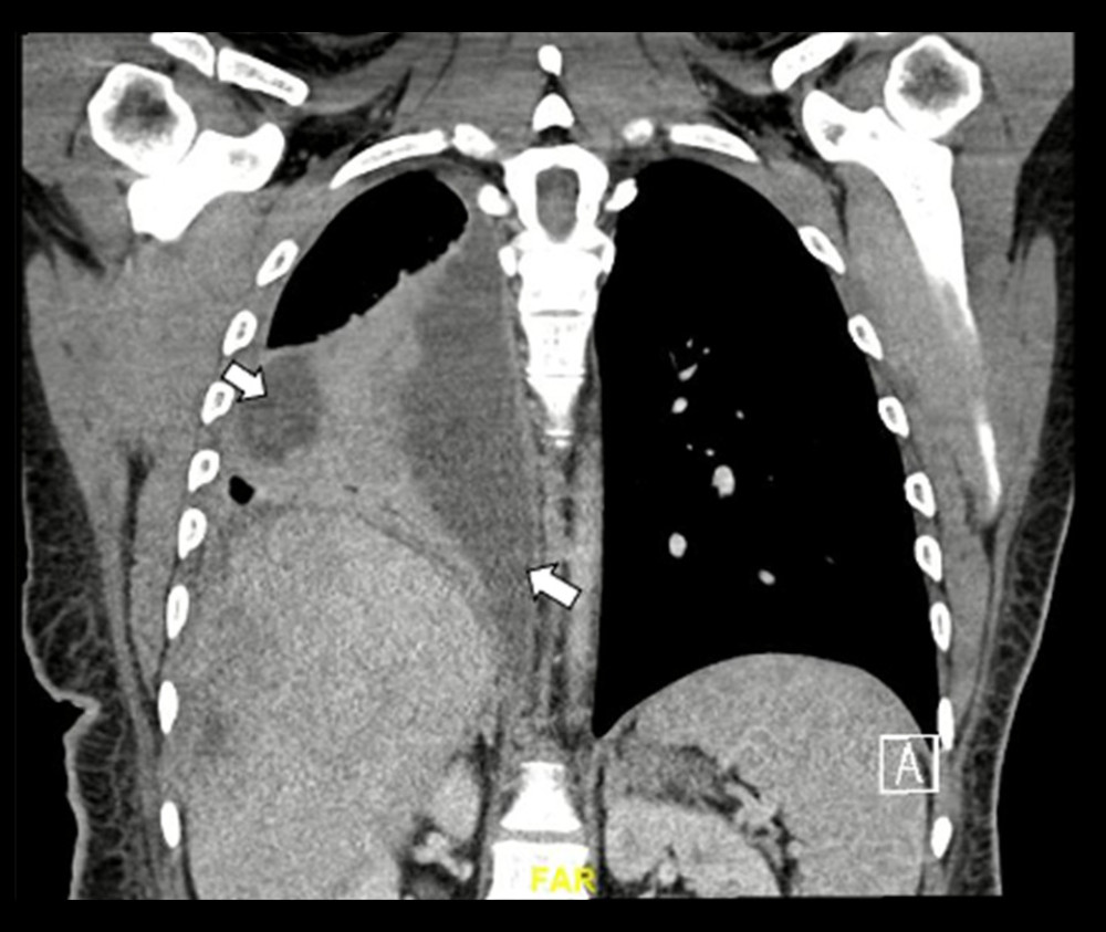 Contrast-enhanced CT of the chest illustrating the presence of a massive right-sided pleural effusion with multiple septations (white arrows).