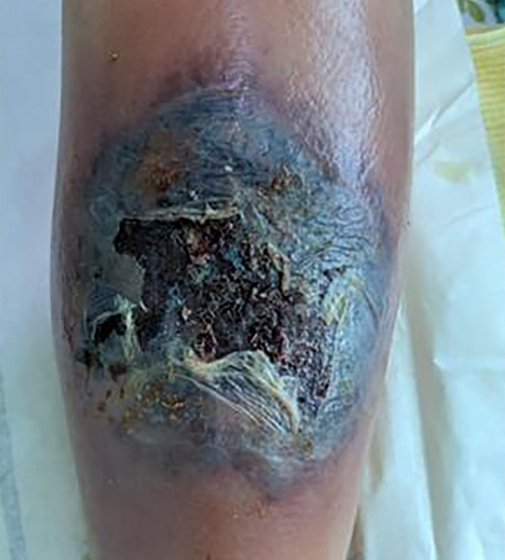 Necrotic lesions of pyoderma gangrenosum on the lower left leg.