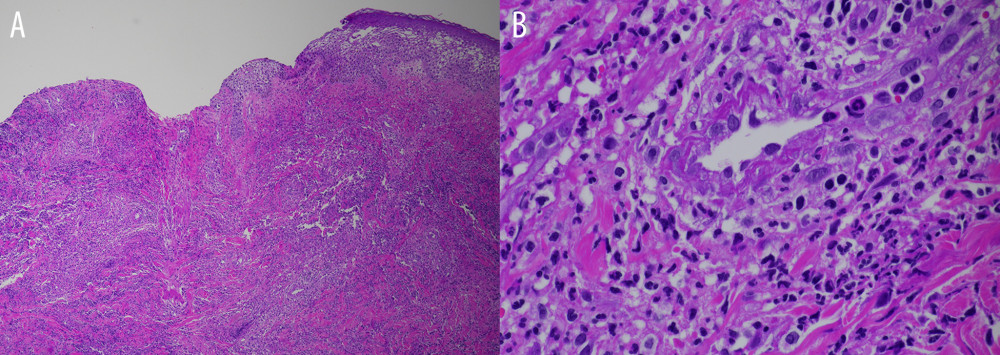 (A) The skin shows ulcer and diffuse neutrophilic infiltrations in the dermis. (B) The dermal blood vessel shows vasculopathy with partial fibrinoid necrosis and no thrombosis is noted.