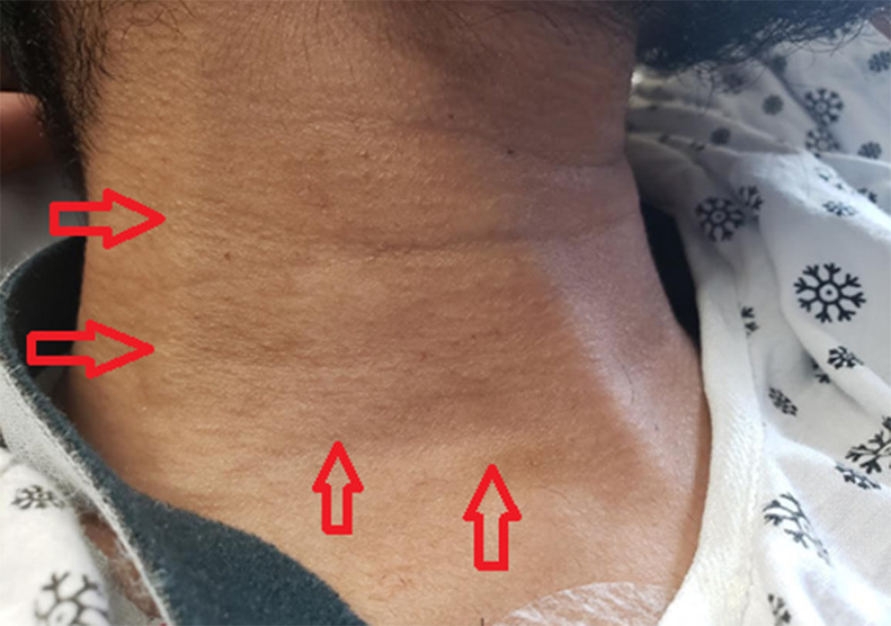 Initial presentation of the patient: physical exam was significant for engorgement of the neck veins (shown by the arrows).