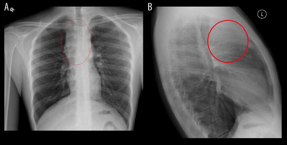 (A) Chest X-ray (PA view) showing large mediastinal mass (marked fullness in the right suprahilar, paratracheal, and anterior superior mediastinal region, predominantly right-sided). (B) Chest X-ray (lateral view), mediastinal mass outlined.