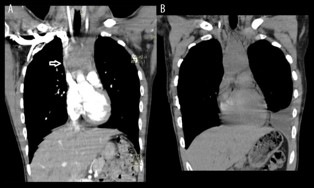 (A) CT scan of the chest with IV contrast showing large, heterogenous, solid soft tissue mass in the anterior mediastinum (8.4×8.1×5.1 cm) with extrinsic compression and narrowing of the superior vena cava in right paratracheal space by the mass. (B) Follow-up CT scan of the chest showing interval reduction in the size of mediastinal mass (4.6×4.0×7.5 cm, compared to 8.1×5.1×8.6 cm on the prior CT examination).