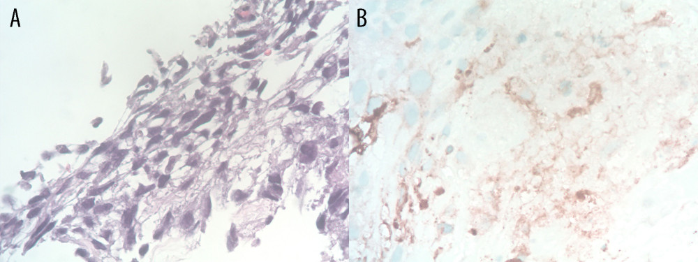 (A) H&E stain showing spindle features (40× mag). (B) PLAP positive stain (Immunohistochemistry, 40× mag).