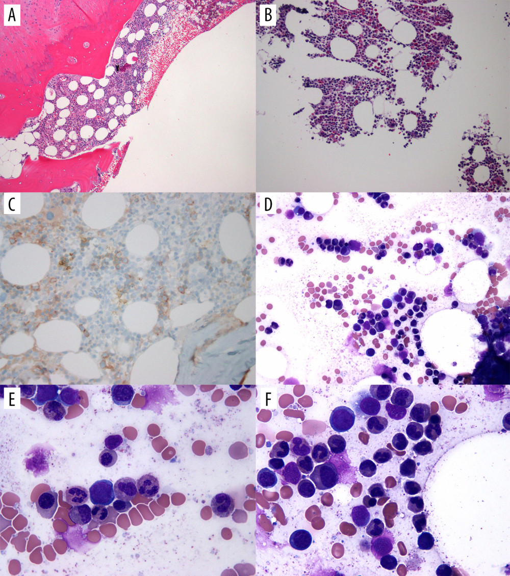 Bone marrow biopsy. (A) Bone marrow core biopsy at 10× magnification with hematoxylin and eosin staining. Normal cellularity with a predominance of myeloid cells and normal megakaryocytes. (B) Bone marrow aspirate at 20× magnification with hematoxylin and eosin staining. (C) Bone marrow core biopsy with magnification 40× with ecadherin staning. The ecadherin immunostain highlights small erythroid islands in the bone marrow core biopsy, overall decreased in number. (D) Bone marrow aspirate smear magnification 40×. This smear demonstrates predominance of myeloid. (E) Bone marrow aspirate smear magnification 100×. This smear demonstrates predominance of myeloid maturation without dysplasia and only rare erythroid precursors, consistent with erythroid hypoplasia. (F) Bone marrow aspirate smear magnification 100×. This smear demonstrates predominance of myeloid maturation without dysplasia.