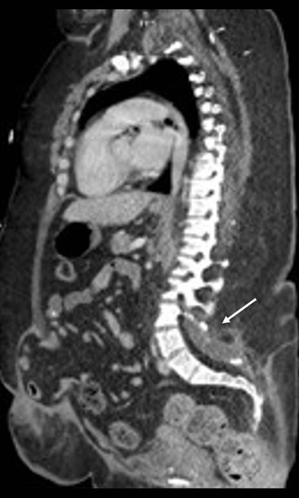 Sagittal computed tomography image identifying no intra-abdominal bleeding, chronic spina bifida occulta (arrow), and chronic ventral hernia.