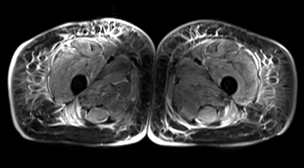 MRI of the thighs shows abnormal signals in the subcutaneous fat of both thighs, with a reticular pattern. There is a feathery hyperintense signal within the muscles of the anterior and posterior compartment of the right and left thigh, suggesting interstitial edema.