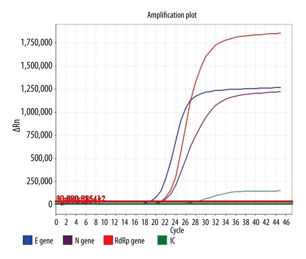 Real-Time Polymerase Chain Reaction response plot of patient smear on April 12, 2021. ABI7500. Red color: RdRp gene (threshold 30 000), purple color: gene N (threshold 30 000), blue color: gene E (threshold 30 000), green color: IC (threshold 10 000).