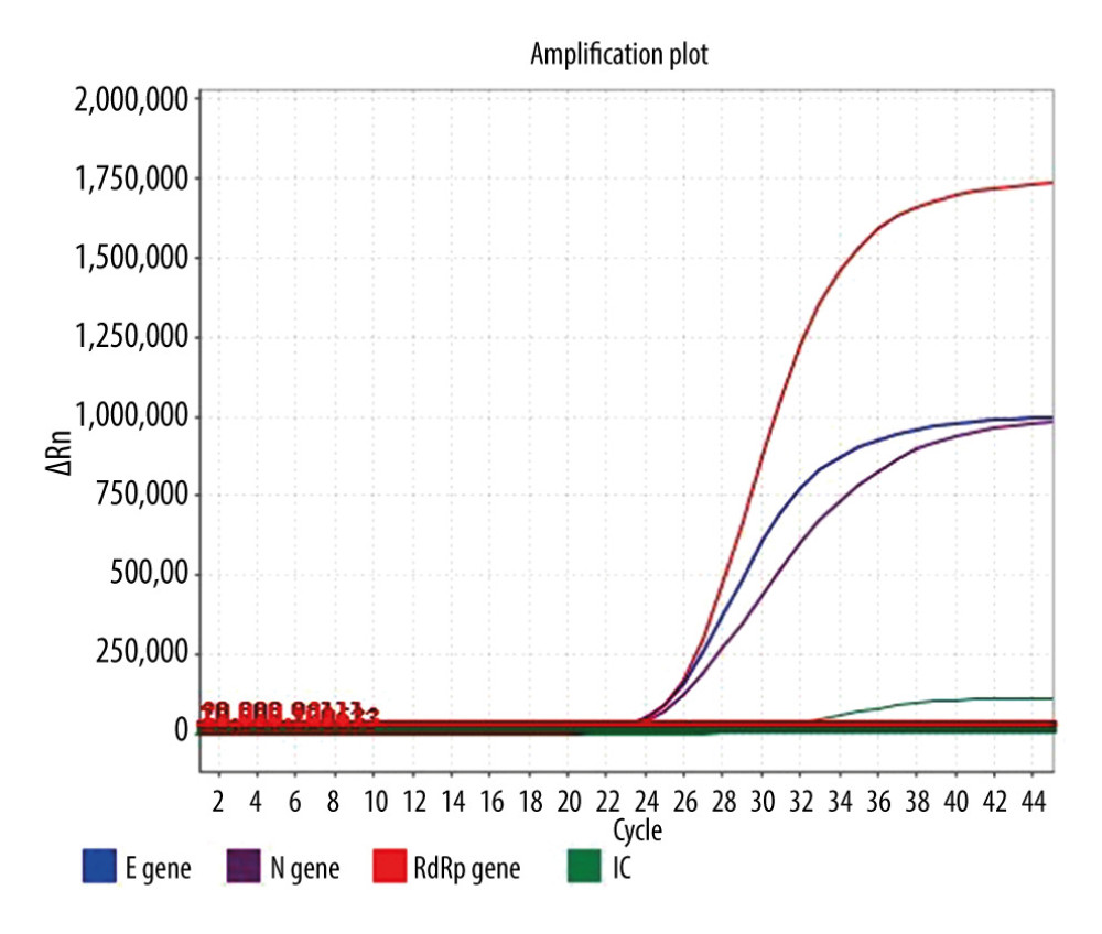 Real Time Polymerase Chain Reaction of a patient smear collected on July 23, 202 during readmission to the MIM. ABI7500. Red color: RdRp gene (threshold 30,000), purple color: gene N (threshold 30,000), blue color: gene E (threshold 30,000), green color IC (threshold 10,000).