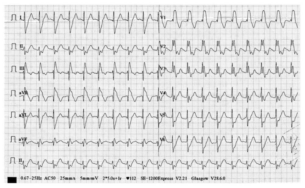 A 12-lead electrocardiogram shows sinus tachycardia, right axis deviation, deep S wave in V 5–6 leads compatible with right ventricular hypertrophy, and complete right bundle branch block.