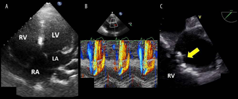 Transthoracic echocardiography demonstrates marked right ventricular dilatation (A), color Doppler M-mode in the parasternal long-axis view shows turbulent flow across the interventricular septum during the systolic phase compatible with ventricular septal defect patch leakage (B). Transesophageal echocardiography shows severe degenerative calcification with limited opening of the pulmonary valve (C) compatible with severe pulmonary stenosis (right ventricle-to-pulmonary artery conduit dysfunction) indicated by the yellow arrow.