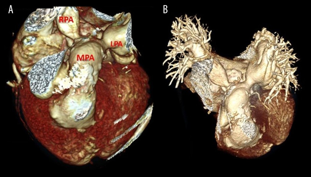 (A, B) Three-dimensional reconstruction of the heart from computed tomography was useful in localizing the sites of stenosis involving the right ventricle-to-pulmonary artery conduit and in understanding anatomical relationships between adjacent structures. The sites of stenosis were the proximal ends of both the right pulmonary and left pulmonary arteries.