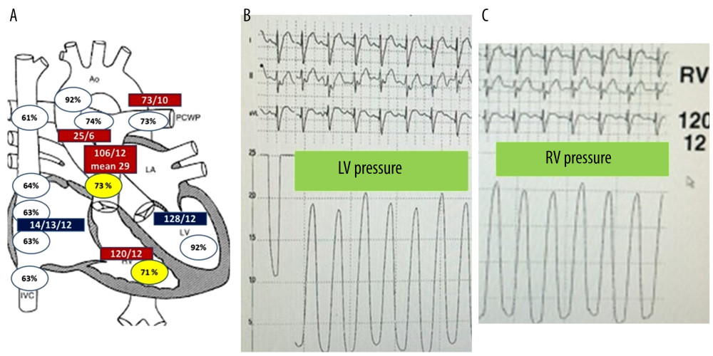 (A–C) The right-left heart catheterization in our patient demonstrated a high right ventricular systolic pressure of 120 mmHg compared with a left ventricular systolic pressure of 128 mmHg. The systolic pressure gradient across the right ventricle to the pulmonary artery (120 to 106 mmHg), the main pulmonary artery (106 mmHg) to both the proximal right pulmonary artery (25 mmHg) and the left pulmonary artery (73 mmHg) were also reported. These findings were compatible with significant right ventricular outflow tract obstruction and significant peripheral pulmonary stenosis. Another finding was significant oxygen step-up from right atrium to right ventricular level (63% to 71%, respectively). Therefore, either an intracardiac shunt at the ventricular level or VSD patch leakage with a left-to-right shunt was confirmed in our case.