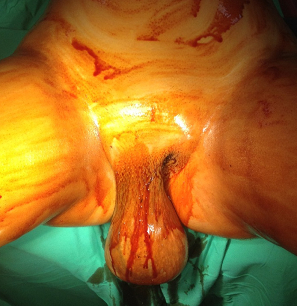 Giant vulvar polyp before surgery (Phone camera, Apple I phone, Foxconn Technology Group).