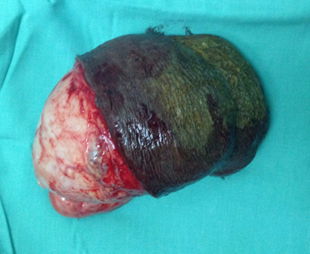 Giant vulvar polyp after surgery (Phone camera, Apple I phone, Foxconn Technology Group).