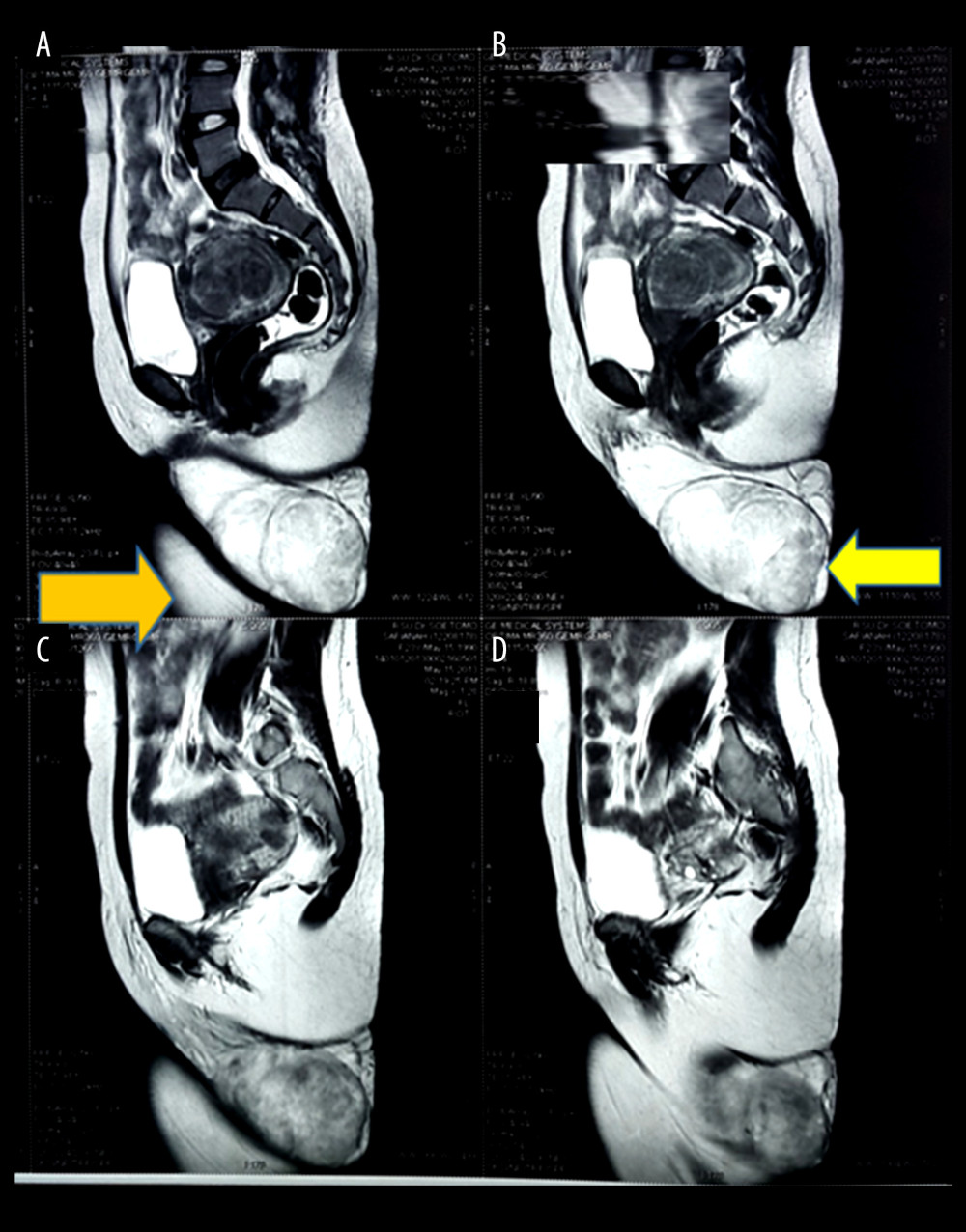 (A–D) MRI pelvic (Phone camera, Apple I phone, Foxconn Technology Group).