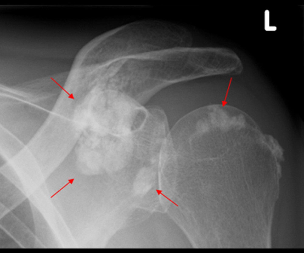 A 46-year-old male patient with ESRD and painful motion of the left shoulder. X-ray examination showed metastatic calcification (red arrows) around the joint structures of the left shoulder.