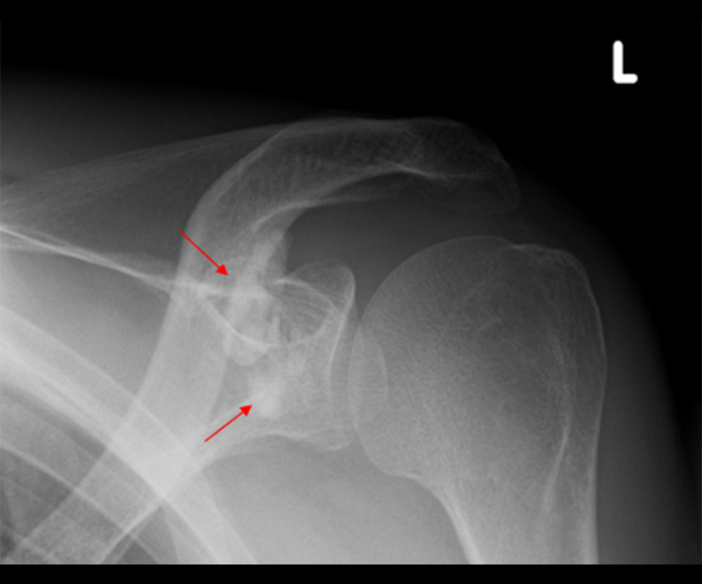 A 46-year-old male patient with ESRD after sustained lowering of phosphate levels to normal levels. The X-ray examination showed markedly reduced metastatic calcification (red arrows) around the joint structures of the left shoulder.