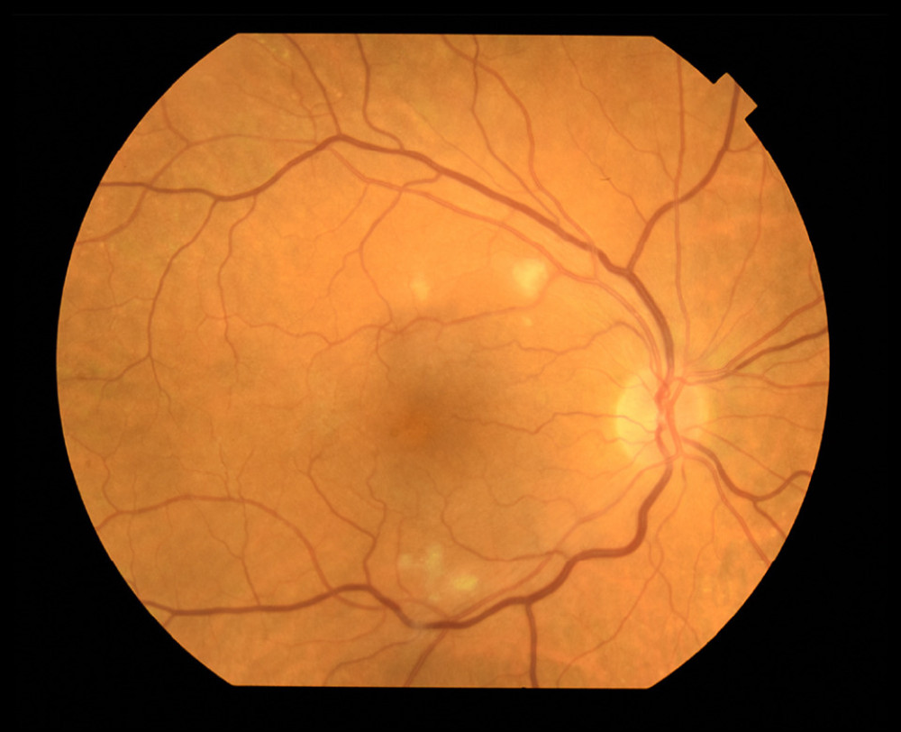 Fundus of right eye: cotton wool spots in the area of watershed zones seen in fluorescein angiography.