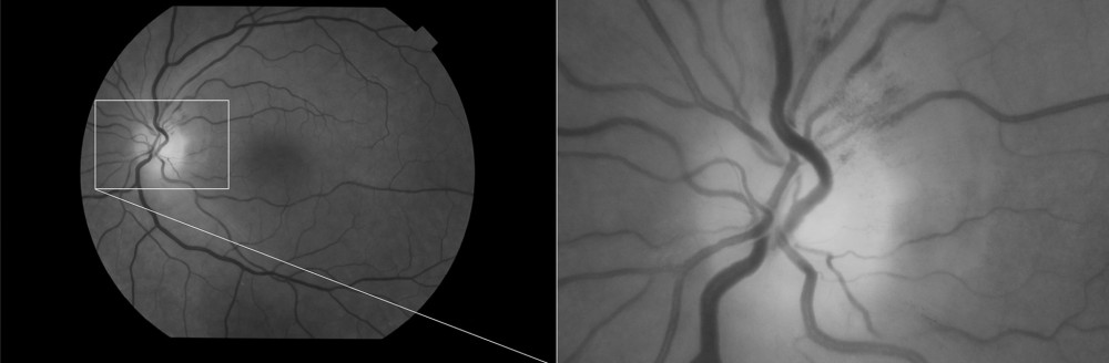 Fundus of left eye (red-free): blurring of the optic margins with flame hemorrhages.