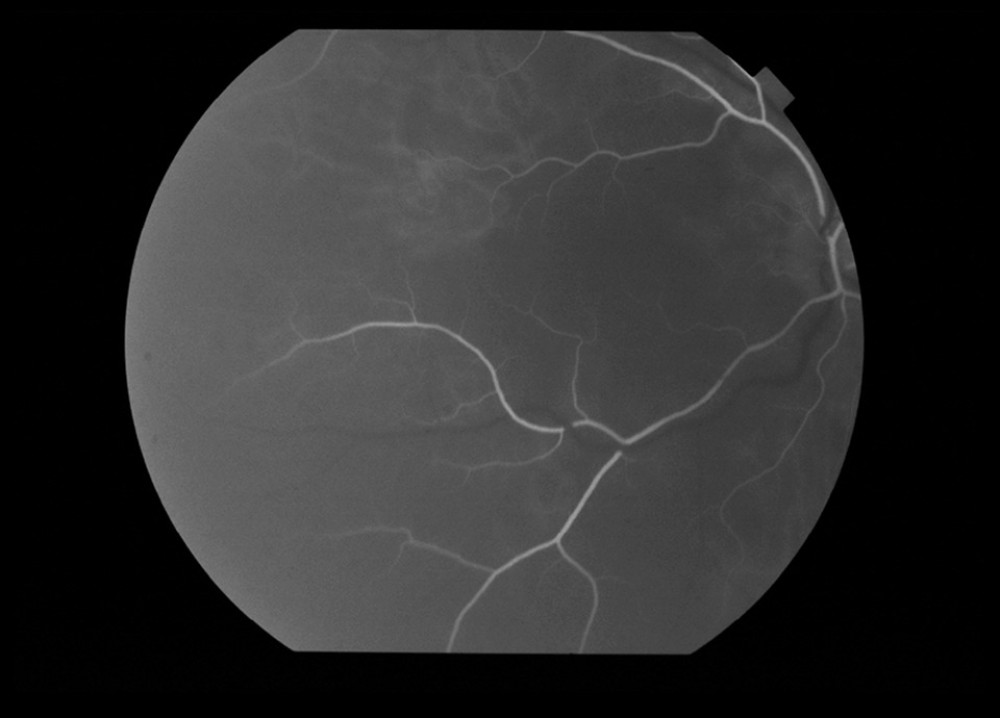 Fluorescein angiography of right eye, with time frame of 15.6 s: delayed choroidal filling.