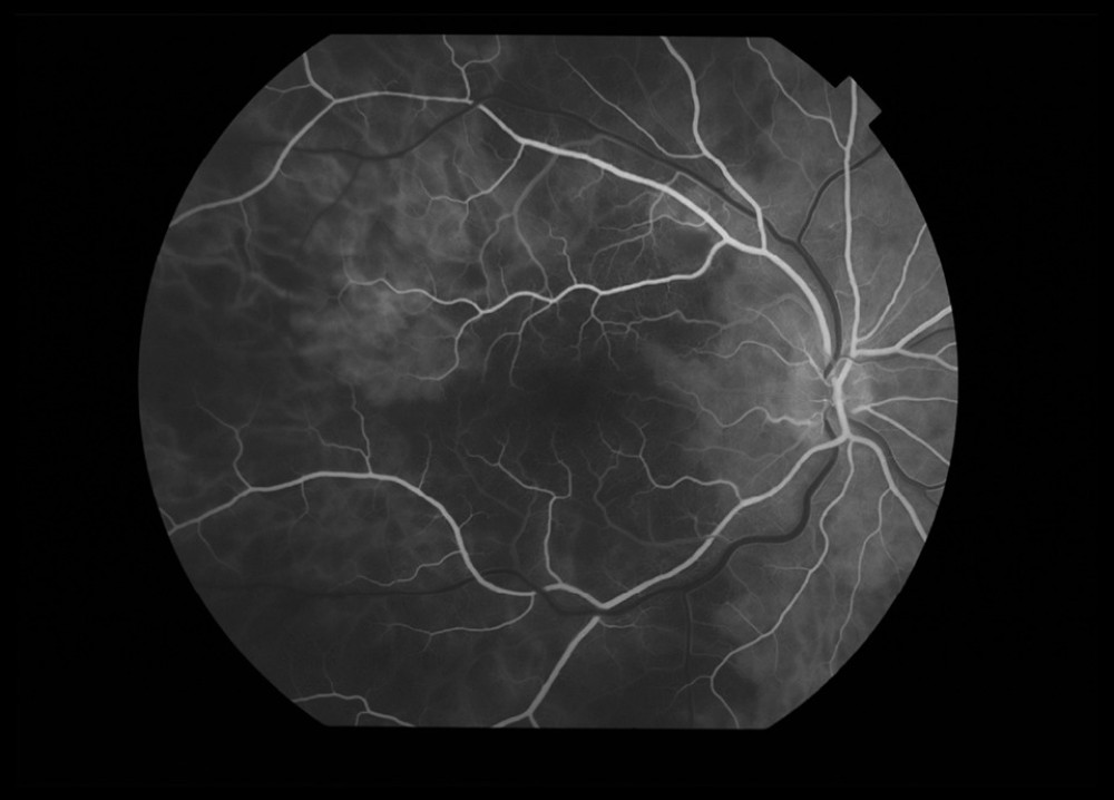 Fluorescein angiography of right eye, with time frame of 17.7 s: watershed zones.