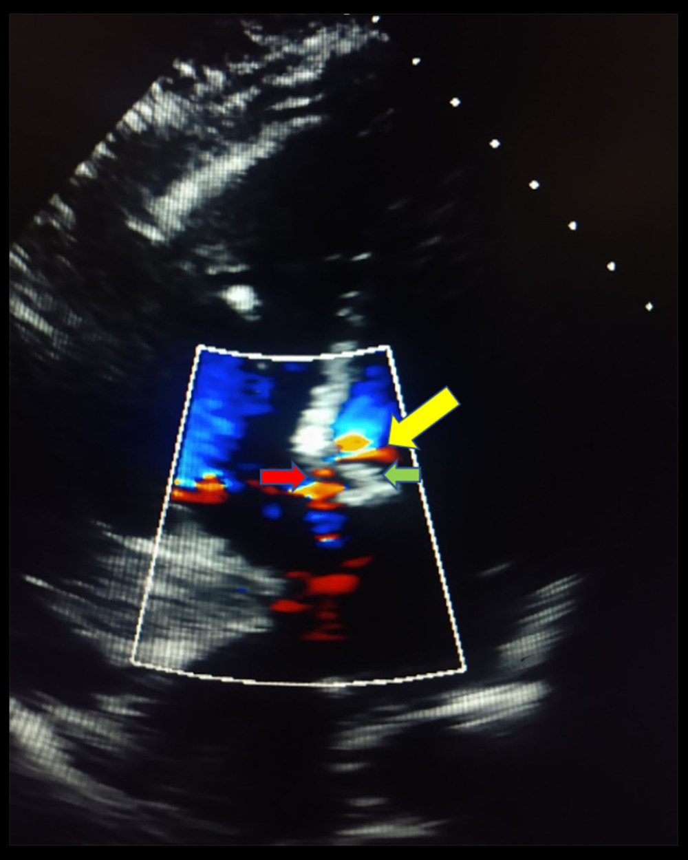 Apical 4-chamber view demonstrating chordal systolic anterior motion (SAM) with an intracavitary gradient at the level of the chordae with turbulent flow through the outflow tract. The yellow arrow indicates the intracavitary flow acceleration through the left ventricle outflow tract (LVOT) due to chordal SAM. The green arrow indicates the anterior mitral leaflets. The red arrow demonstrates the turbulent flow in the LVOT due to chordal SAM before reaching the pulmonic valve.