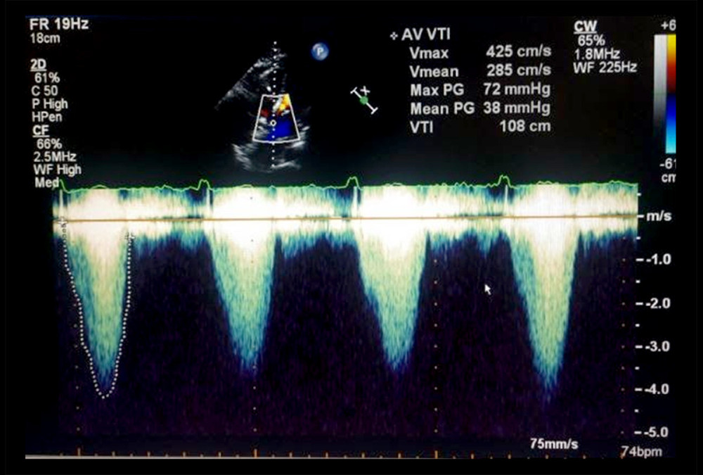 Continuous wave Doppler signals through the pulmonic valve from the right ventricle (the pulmonary outflow tract, non-systemic), suggestive of a peak pressure gradient of 90 mmHg and a mean of 40 mmHg.