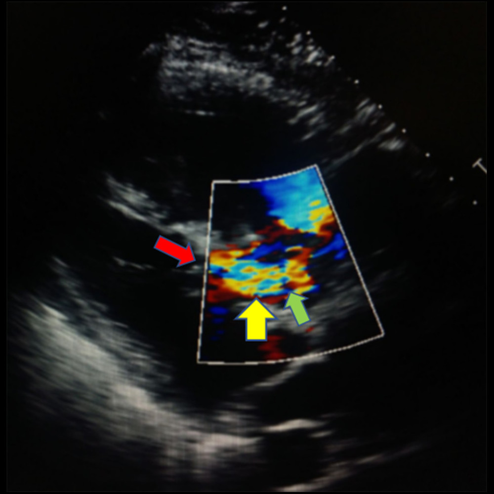 Parasternal long axis transthoracic echocardiogram indicating chordal systolic anterior motion (SAM) with distal turbulent flow leading to the pulmonary vasculature. The green arrow indicates the level of the pulmonic valve. The yellow arrow indicates the left ventricle outflow tract (LVOT) flow acceleration and turbulent flow. The red arrow indicates the chordae tendineae that is along the interventricular septum where the SAM originates.