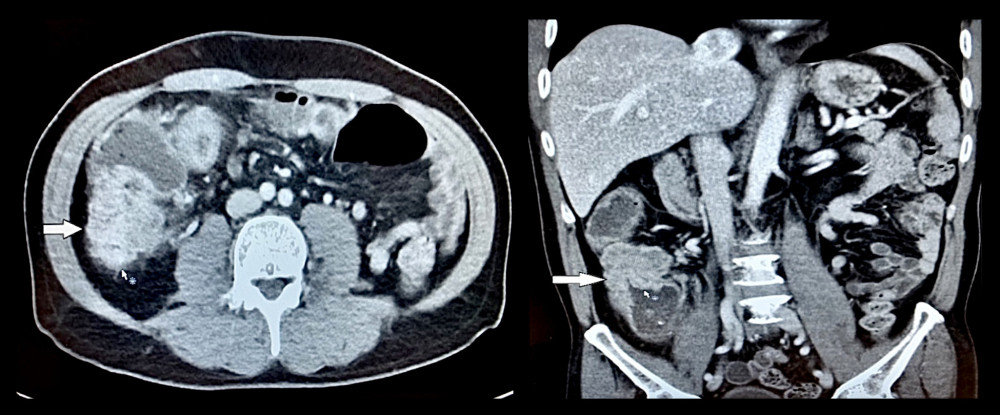 Enhanced CT scan, axial and coronal cuts showing a large ascending colon mass (arrows).
