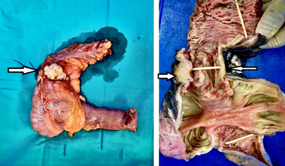 Gross specimen of right hemicolectomy demonstrating a circumferential mass in the ascending colon extending to the serosa (arrows).