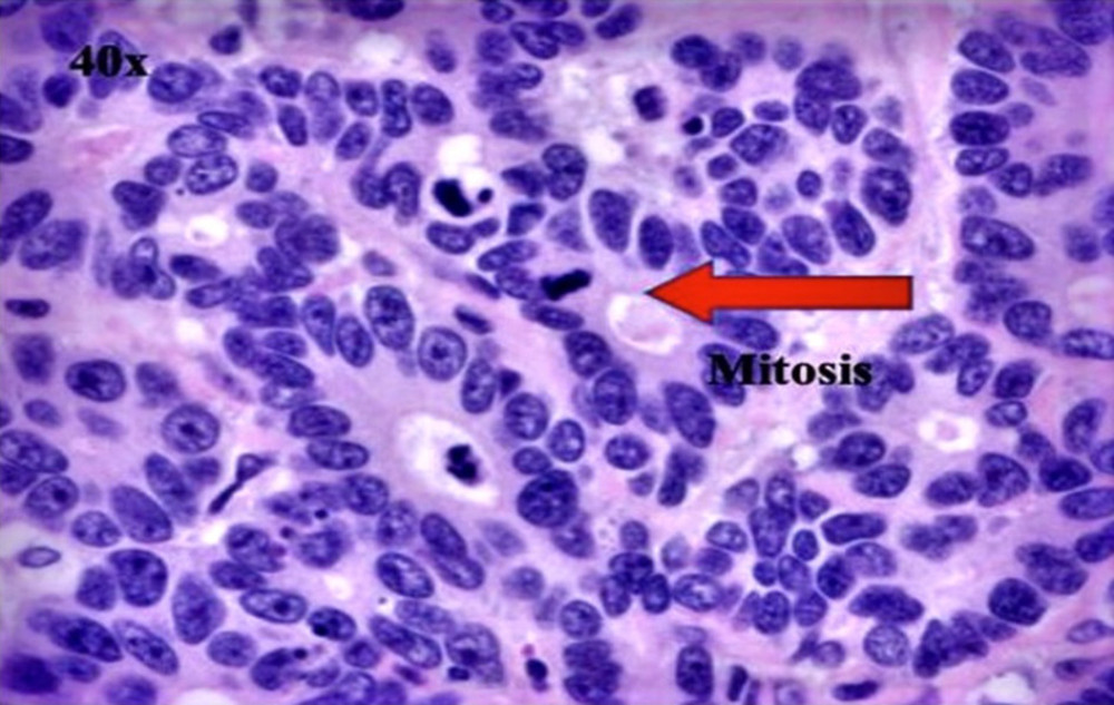 Higher views of the tumor showing the rosette forming tubules with mild nuclear pleomorphism. Frequent mitosis is noted.