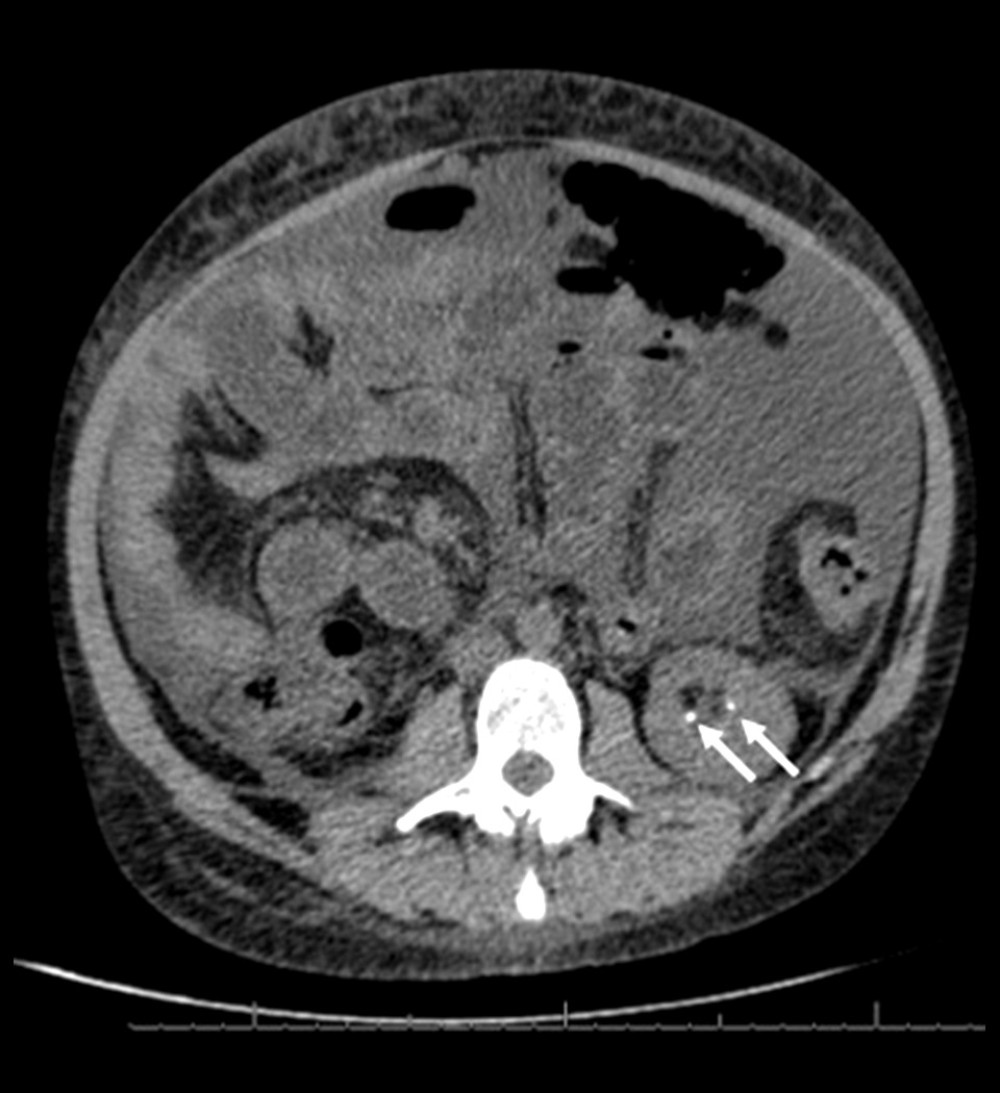 Kidney stones (white arrows) in the patient with autoimmune liver disease and dRTA.